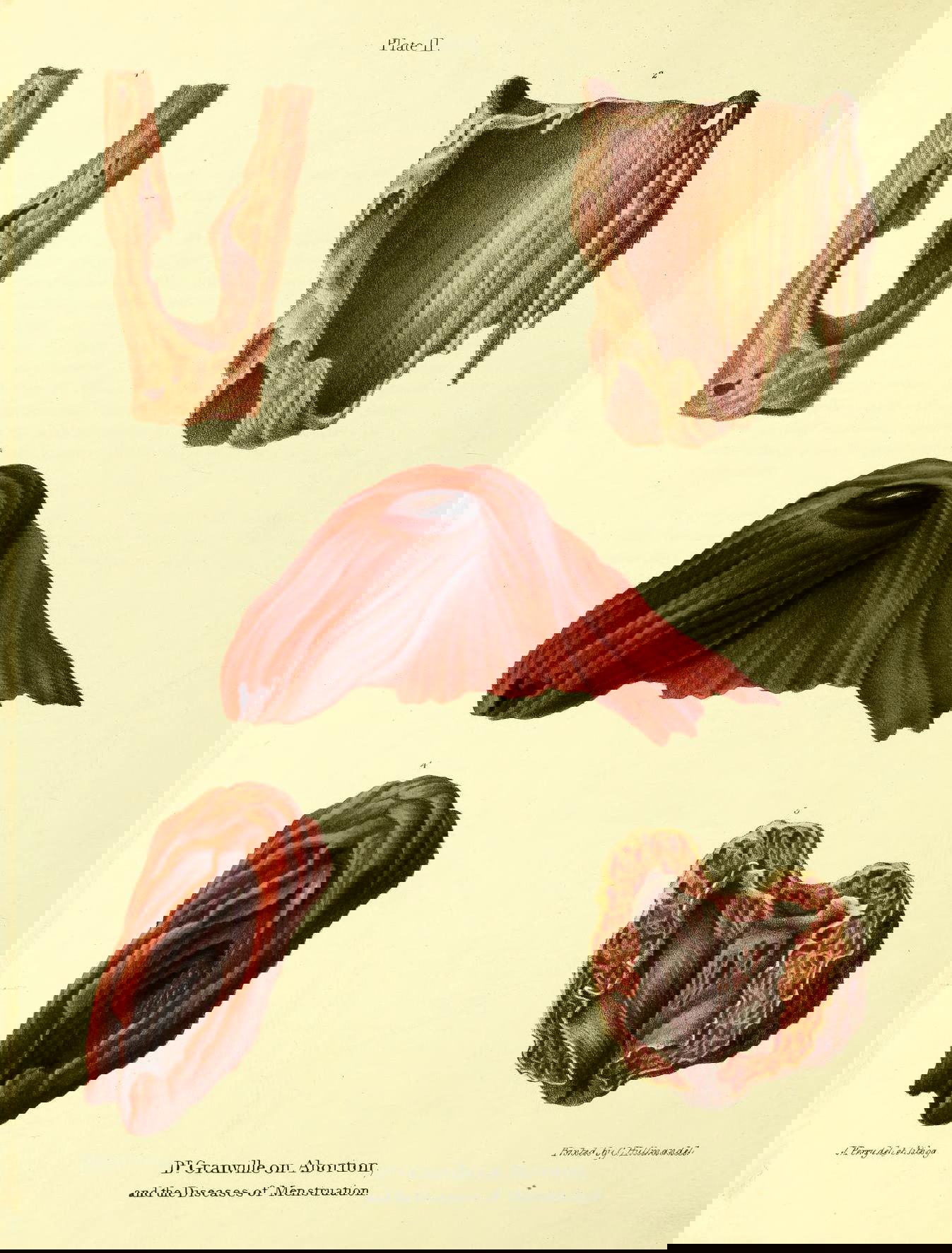 19th-century illustration of miscarriage